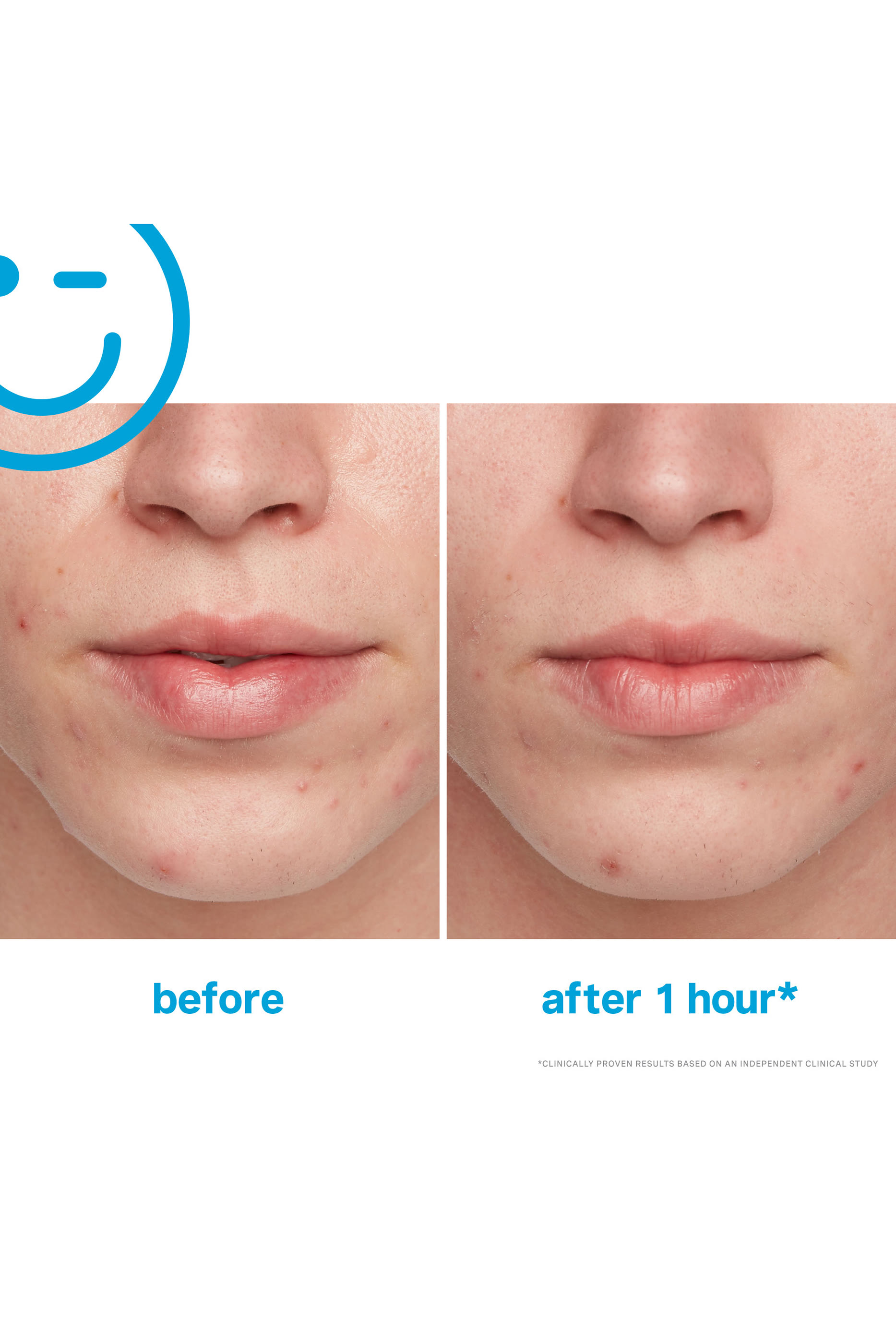 EradiKate&reg; 10% Sulfur Acne Treatment