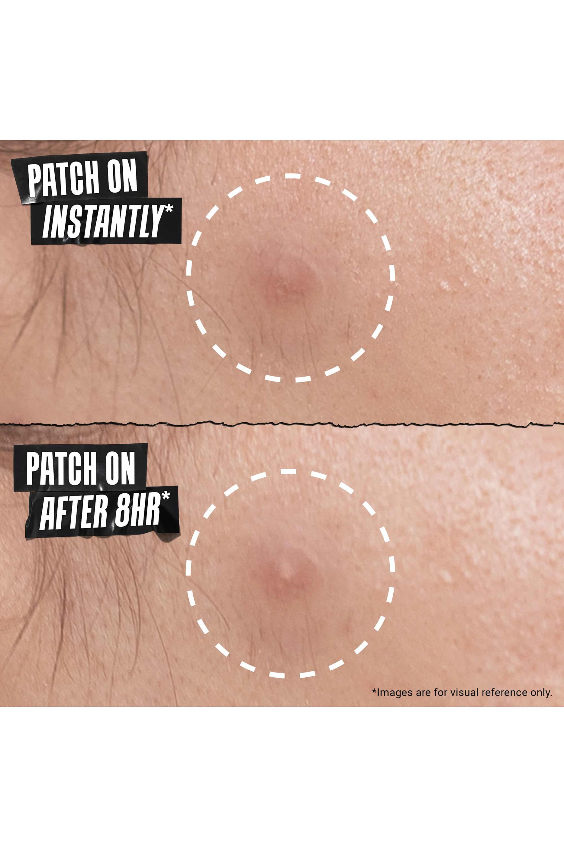 Truly Targeted Overnight Blemish Patch